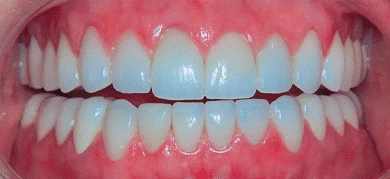 After — Smile transformation 1