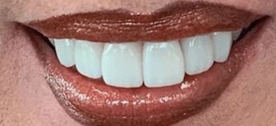 After — Smile transformation 2