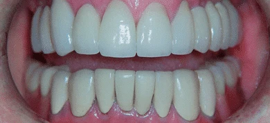 After — Smile transformation 3
