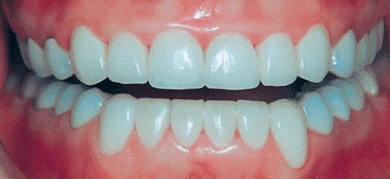 After — Smile transformation 5