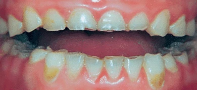 Before — Smile transformation 5