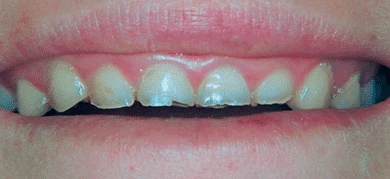 Before — Smile transformation 6